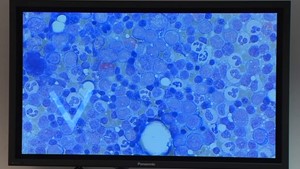 Jena.TV: 1000. Stammzelltransplantation erfolgreich vorgenommen